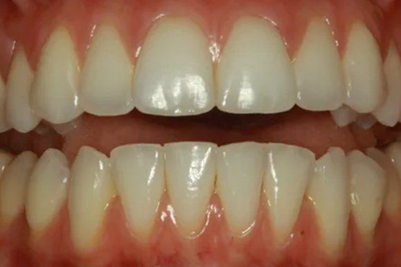 Close-up of healthy human teeth, showing upper and lower rows, with healthy gums and white enamel.