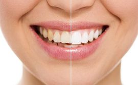 Teeth Whitening — Richardson, TX — Mark L. Ethridge, DDS Teeth Whitening — Richardson, TX — Mark L. Ethridge, DDS