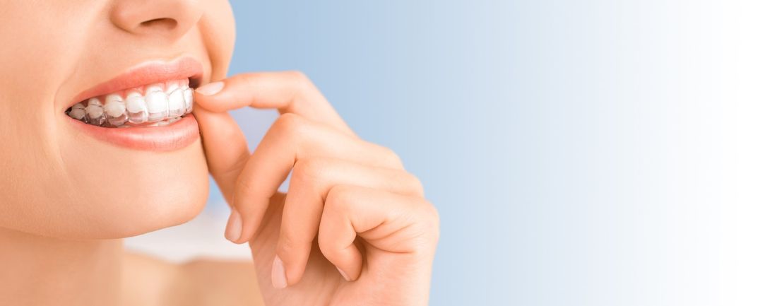 donna che indossa un apparecchio per in denti invisibile