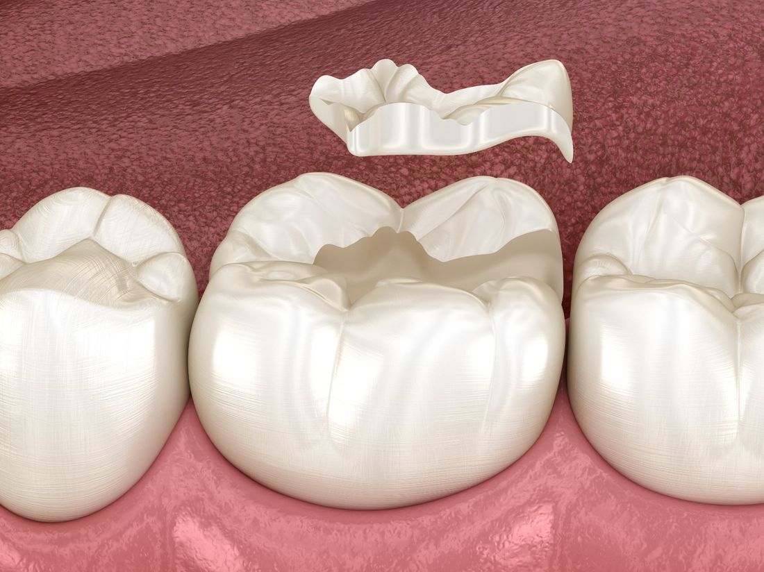 raffigurazione di intarsi dentali