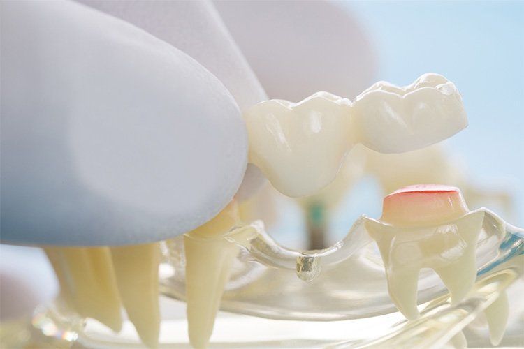 Dental Bridges Hollywood FL 33020