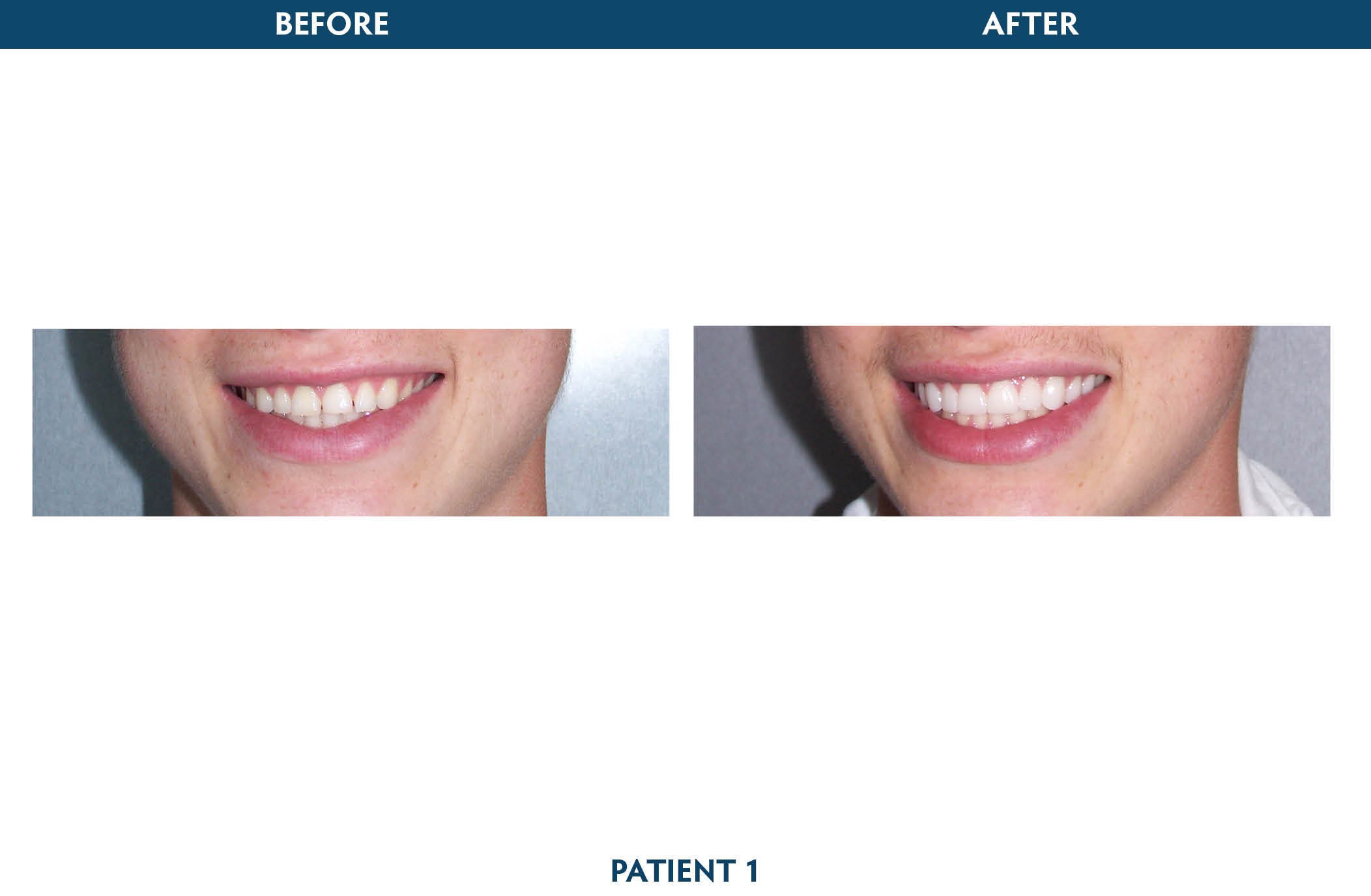 veneers white plains, ny