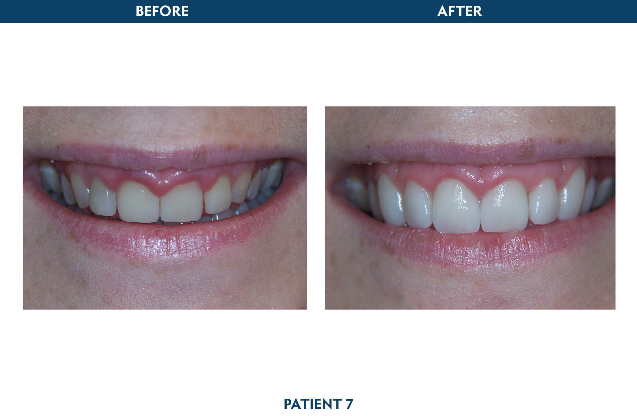 dental implants scarsdale, ny
