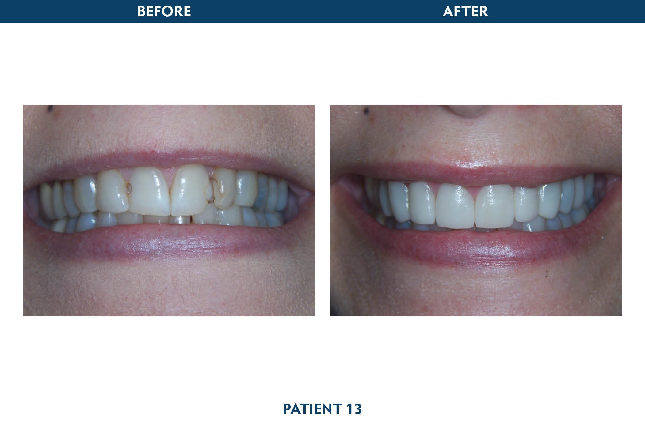 veneers scarsdale, ny