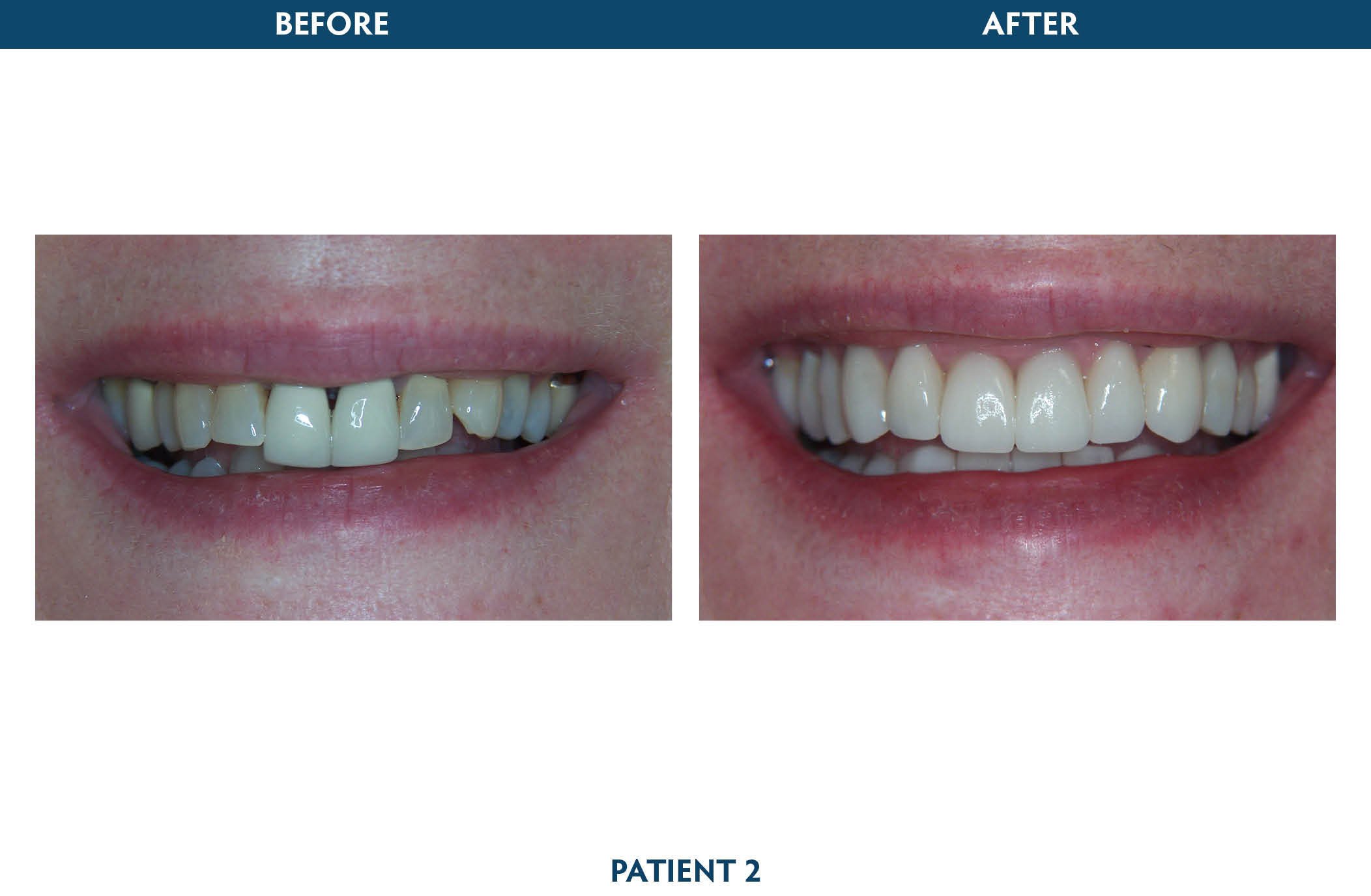 dental crowns white plains, ny