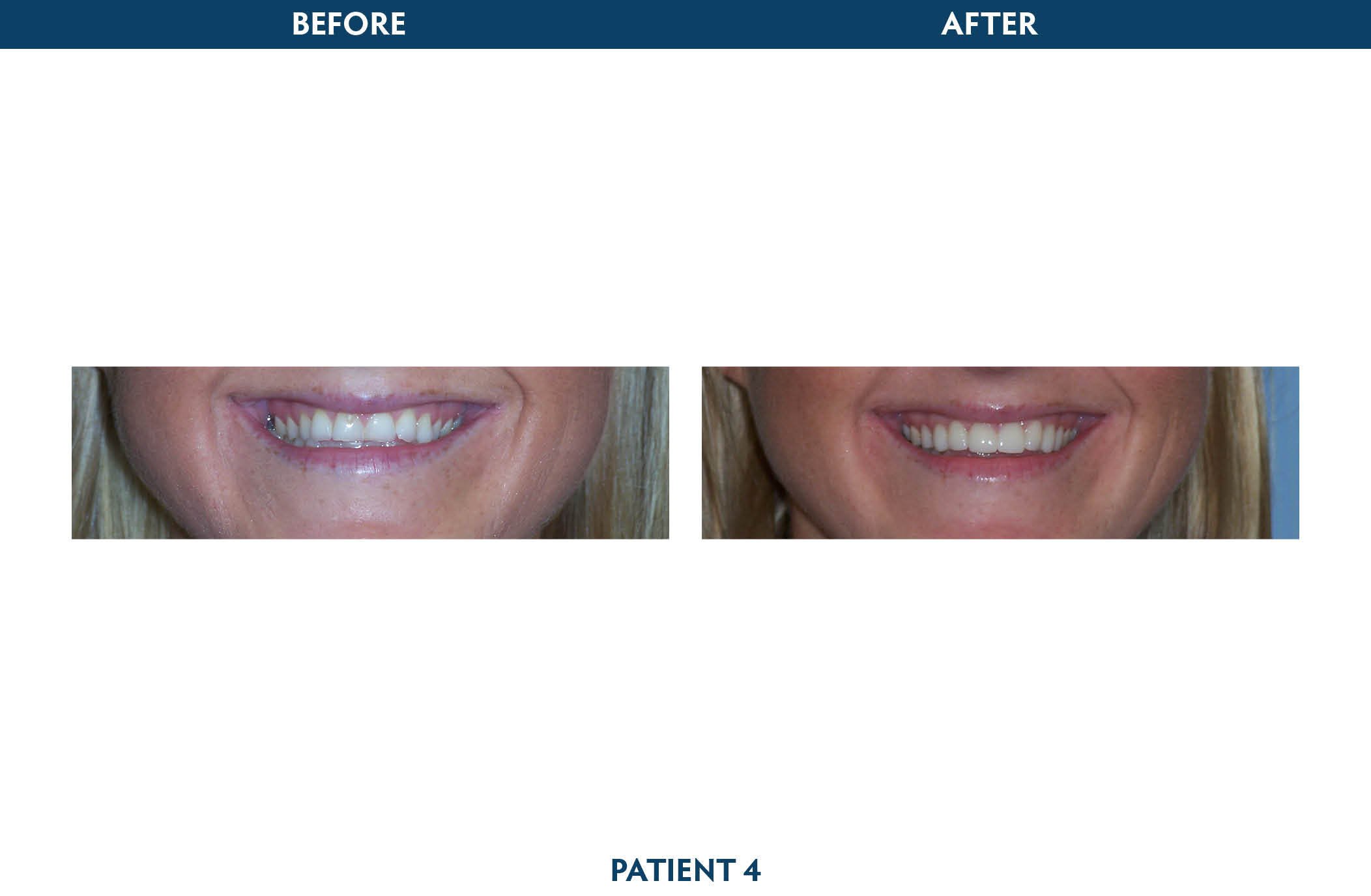 dental implants white plains, ny