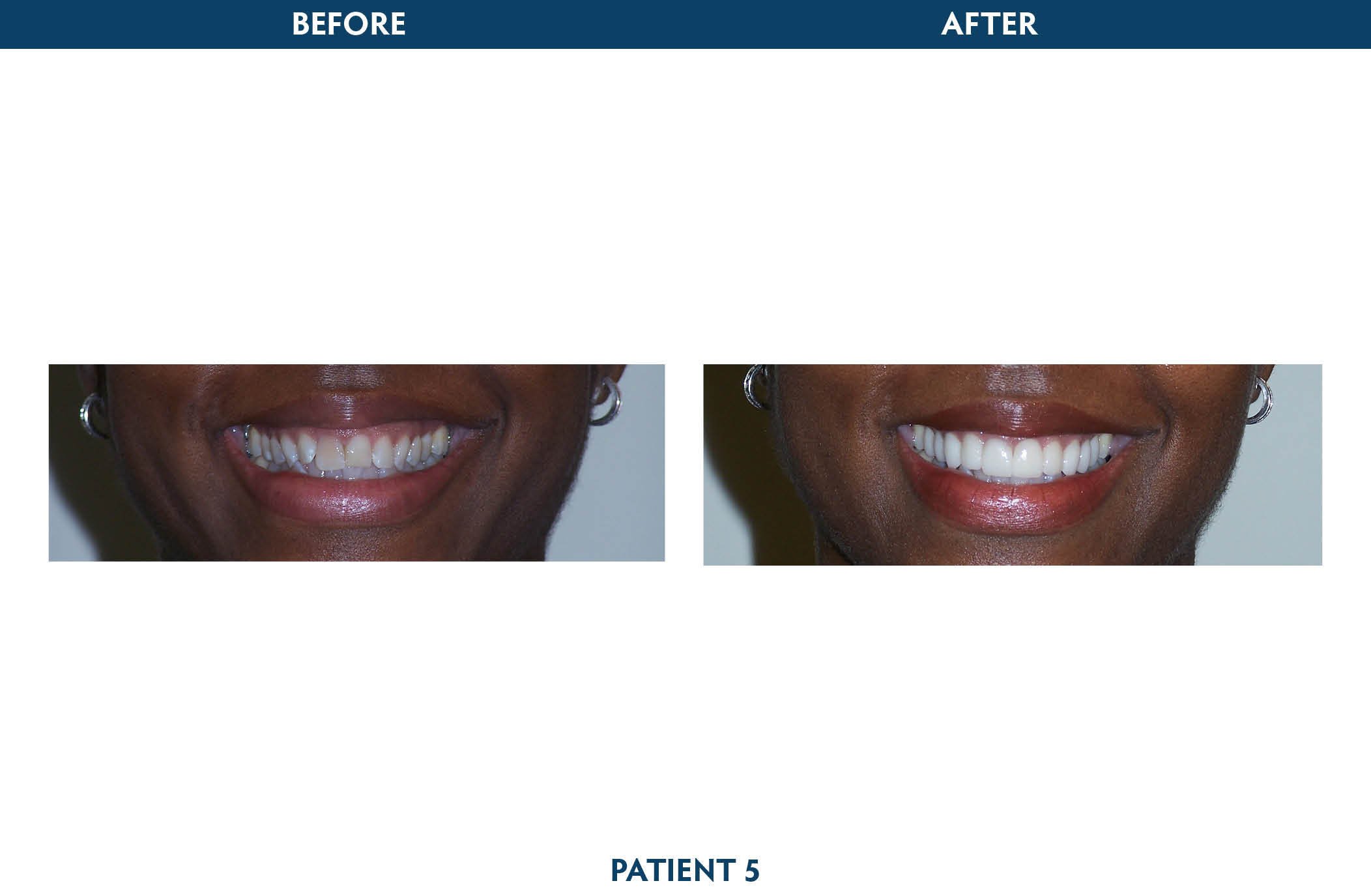 dental crowns scarsdale, ny