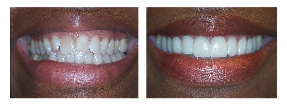White Fillings White Plains NY