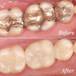 white fillings scarsdale, ny