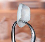 veneers
