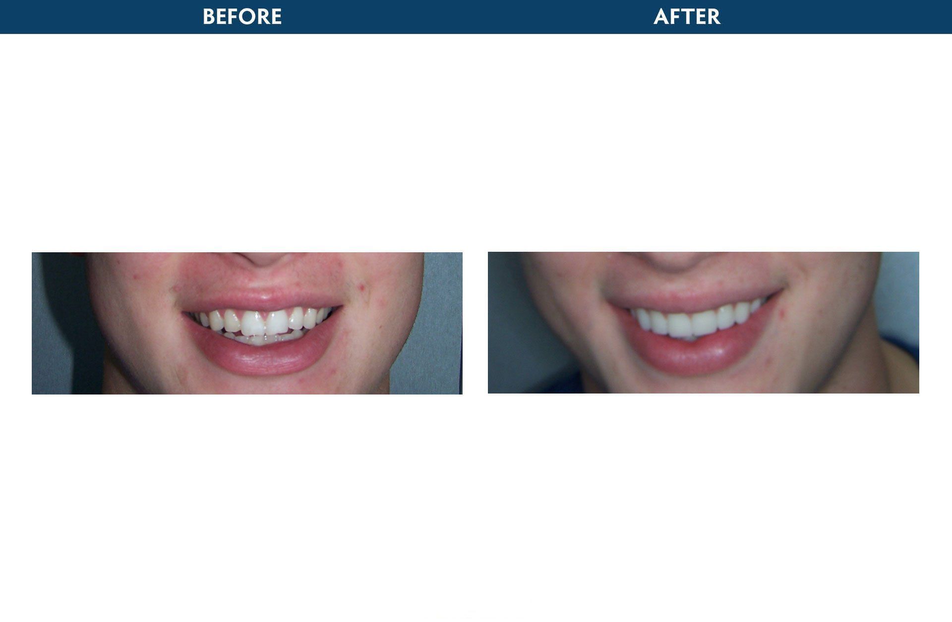 veneers elmsford, ny