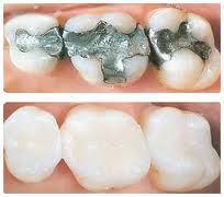 white fillings white plains, ny