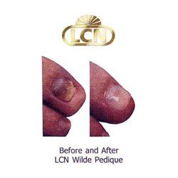 foot nail treatment before and after