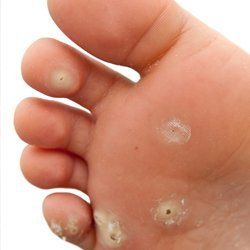 foot corns