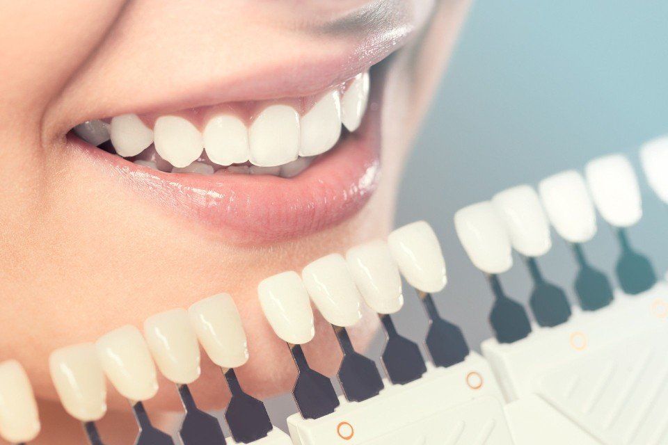 Sbiancamento professionale dei denti