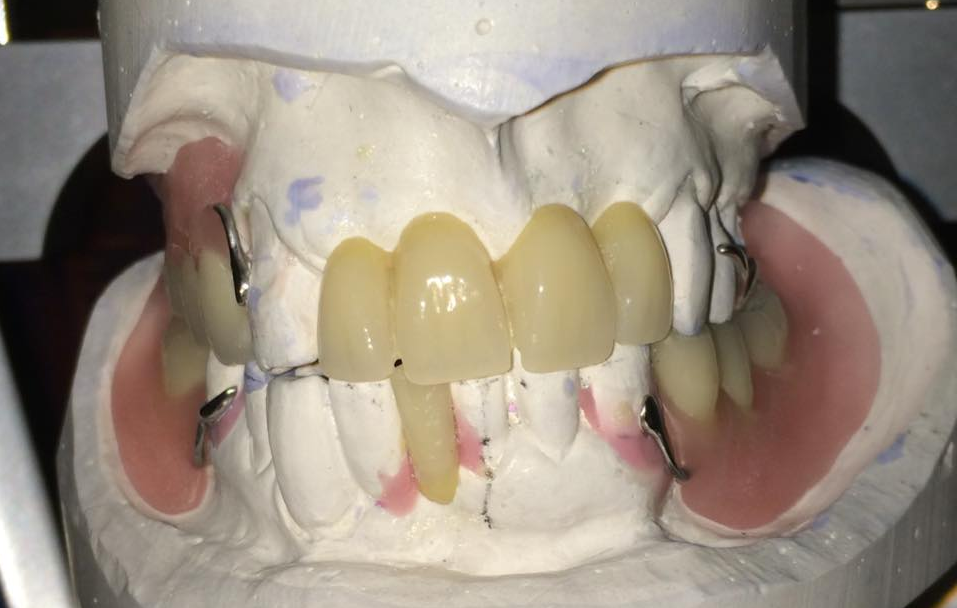 dentures with metal and clay