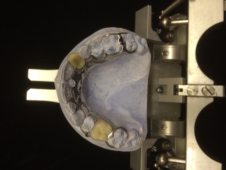metal and false teeth