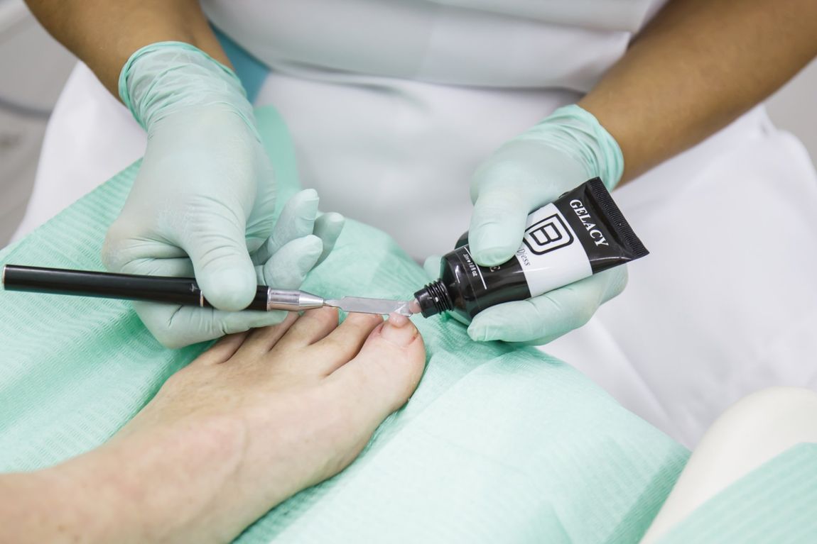 Nagelreparatie / Nagelregulatie
