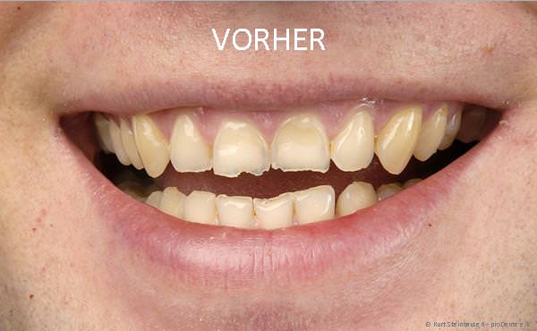 Stark abgenutzte Schneidezähne