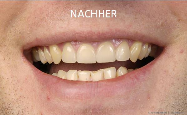 Schneidezähne nach der Behandlung mit Veneers