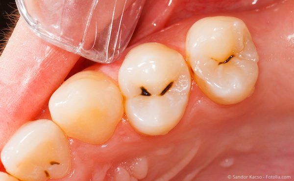 Karies auf kleinen Backenzähnen Karies auf kleinen Backenzähnen