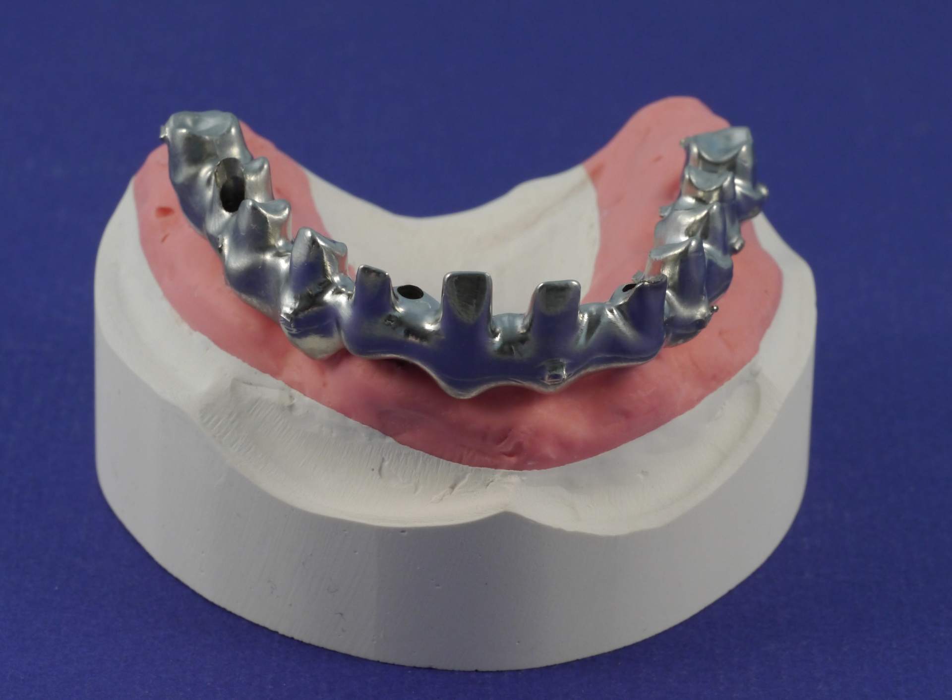Implantatprothetik und 3D-Implantatplanung