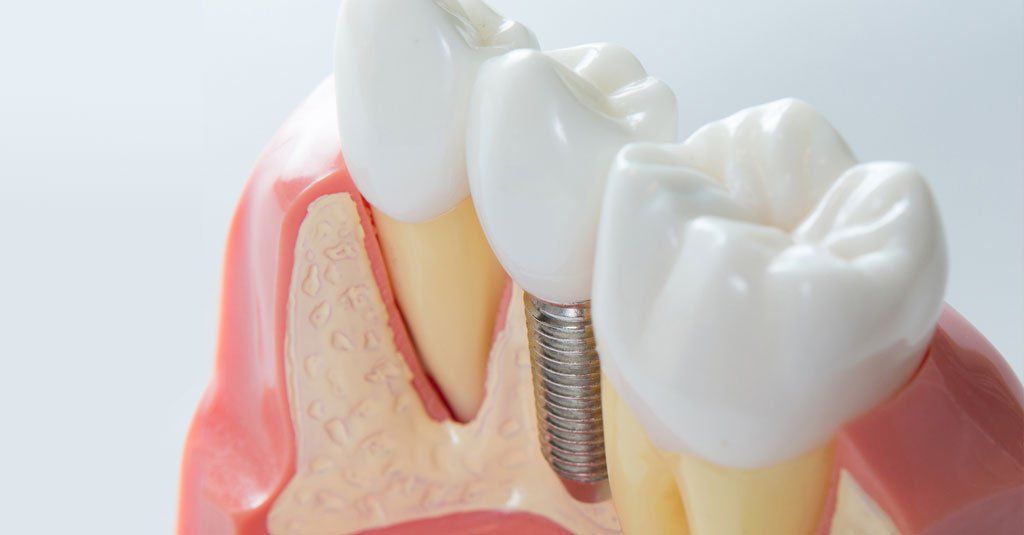 Implantat-Zahnersatz und 3-dimensionale Implantatplanung
