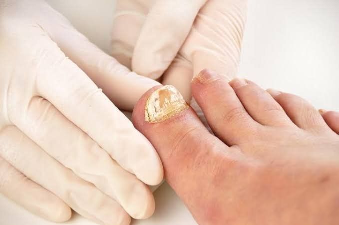 Una persona está recibiendo tratamiento médico para la uña del pie.