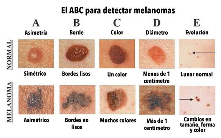 Diagrama que muestra diferentes tipos de melanoma en la piel de una persona.