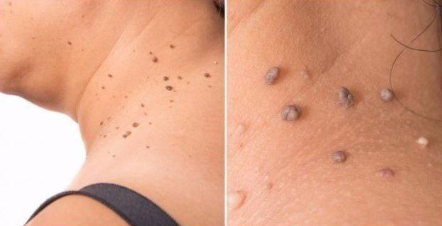 Una fotografía de antes y después del cuello de una mujer con verrugas.