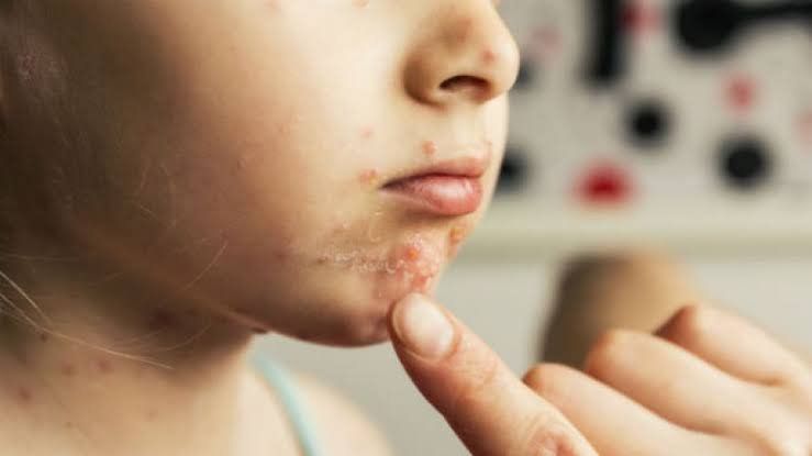 Un primer plano de la cara de un niño con acné.