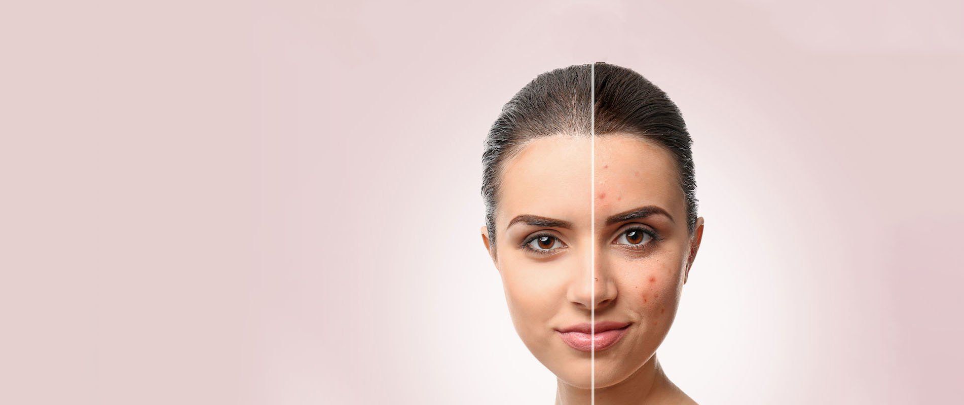 Una fotografía de antes y después de la cara de una mujer con acné.
