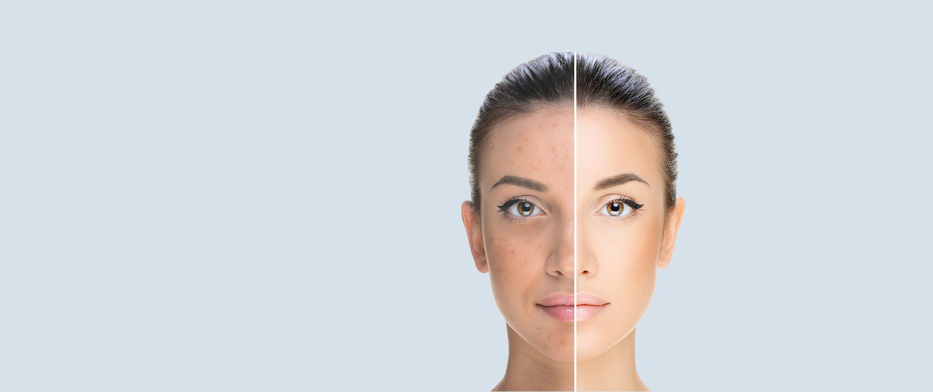 Se muestra el rostro de una mujer antes y después de un tratamiento.