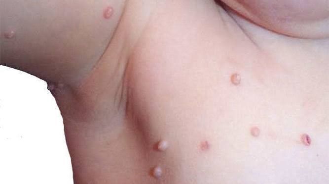 Un primer plano de la piel de un bebé con verrugas.
