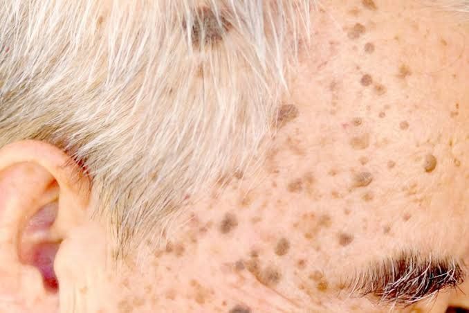Un primer plano de la cara de una persona con cabello gris y pecas.