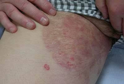 Un primer plano de la pierna de una persona con un sarpullido.