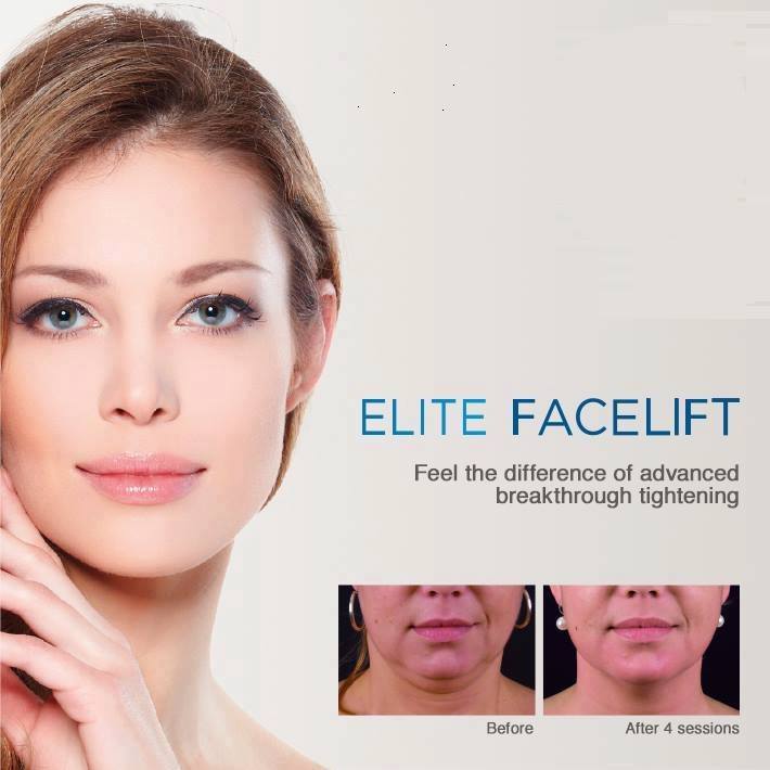 skin tightening exilis ultra