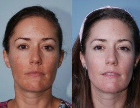 Melasma-Removal-Before-After