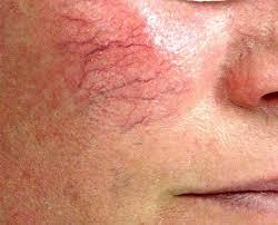 remove veins on face