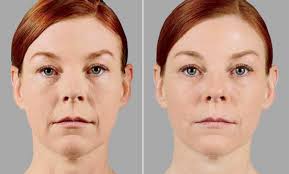 Restylane-Lip-Boston-Providence-RI