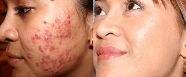 Smoothbeam-Laser-Acne-Treatment-Boston-RI
