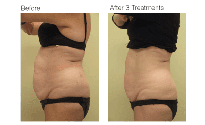 REMOVE BELLY FAT
