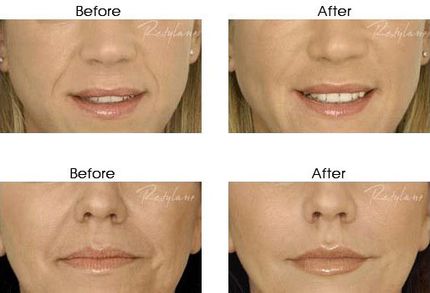 Bigger-Lips-Restylane-Boston-RI