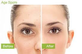 remove brown age spots sun damage freckles