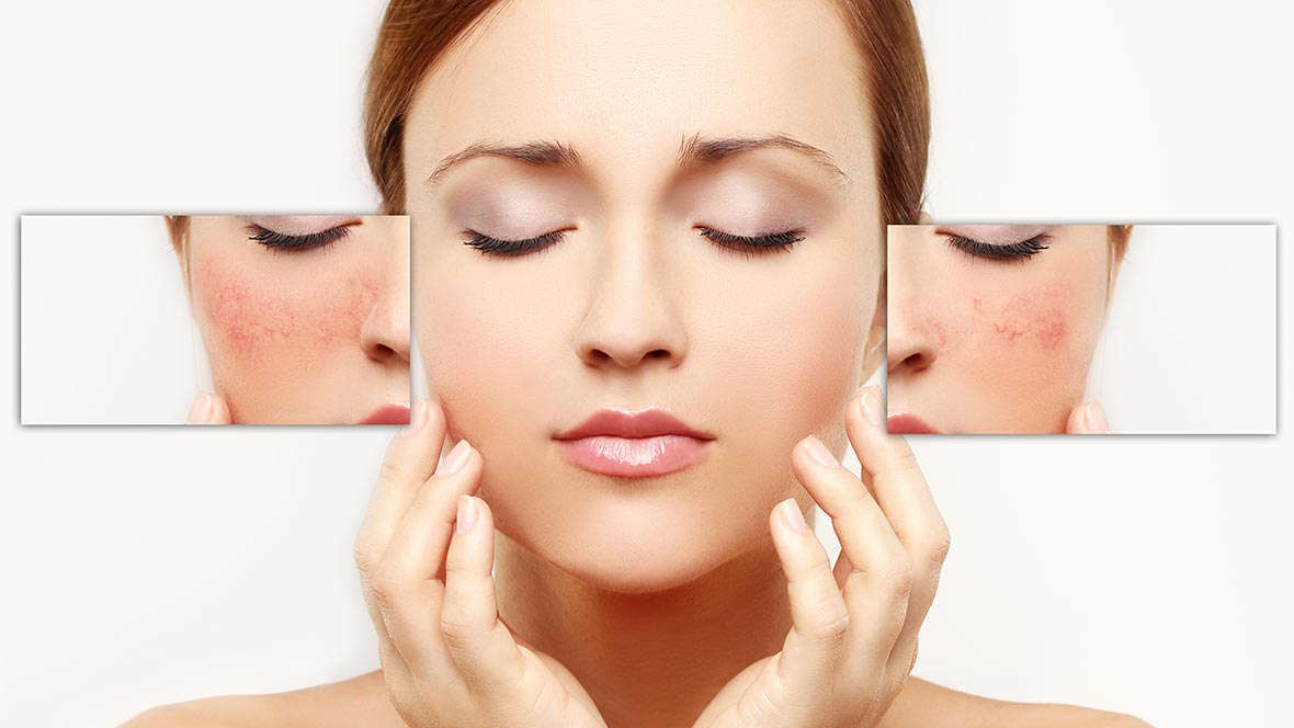 Rosacea laser treatment
