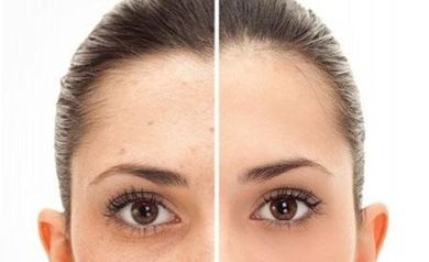 Remove Acne Scars Laser