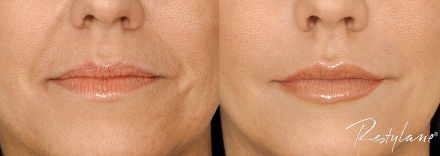 Restylane-Lip-Enhancement-Boston-Rhode-Island