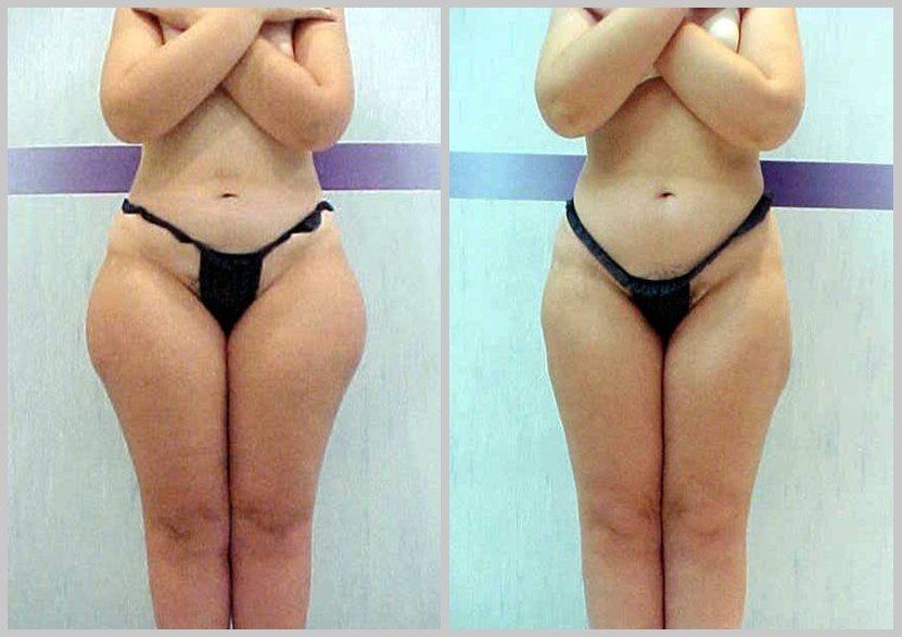 REMOVE THIGH FAT