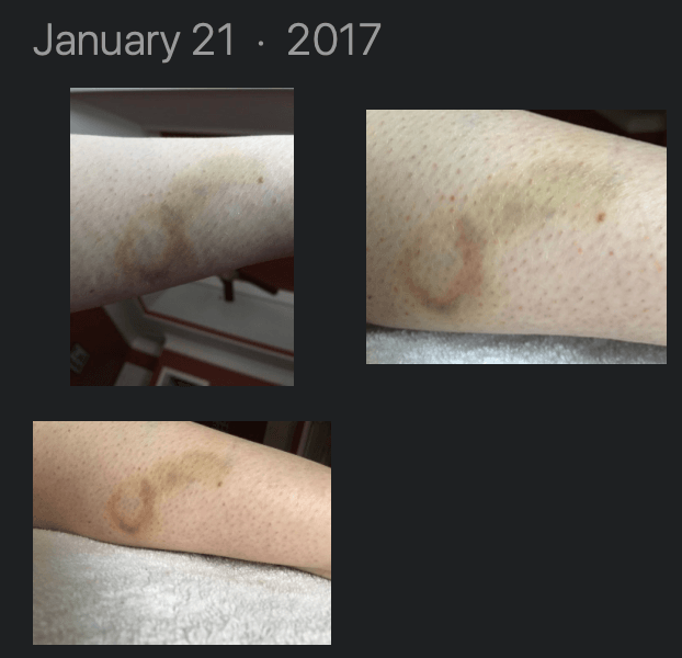 Parapulser - miniZap - Dr Beck Protocol tick bite target Lyme disease indicating photos