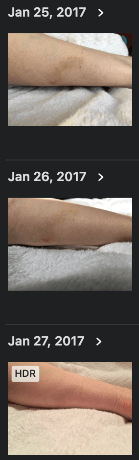 Parapulser - miniZap - Dr Beck Protocol tick bite target Lyme disease remediation photos